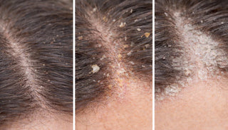 Is It Dry Scalp… or Something Else Going On?